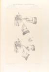 1894. LIBRO. (MEDICINA). GOUGUENHEIM, A.; GLOVER, J.:. ATLAS