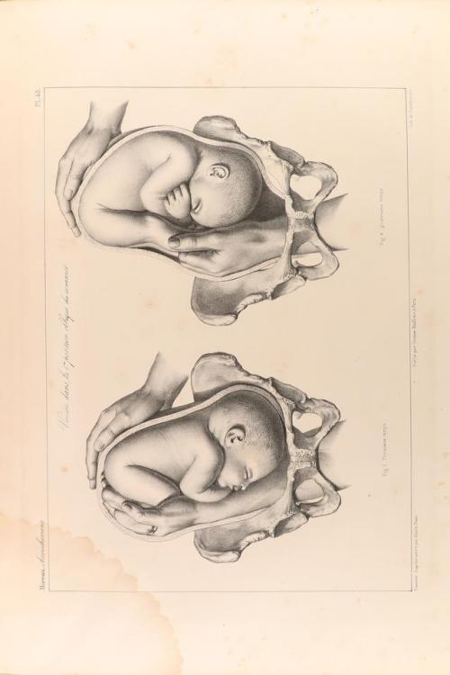 1837-1841. LIBRO. (OBSTETRICIA-MEDICINA). MOREAU, F. J.:. TR